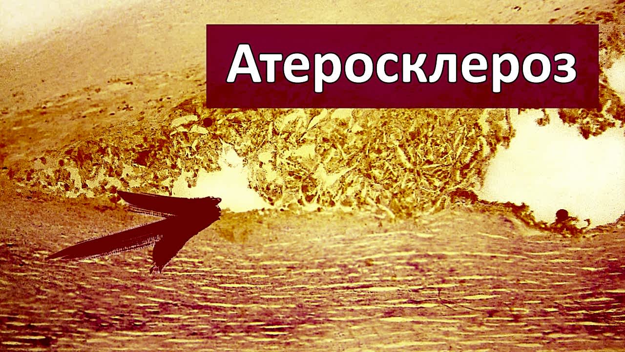 атеросклероз