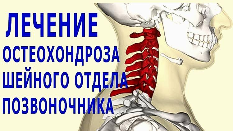 лечение остеохондроза шейного отдела