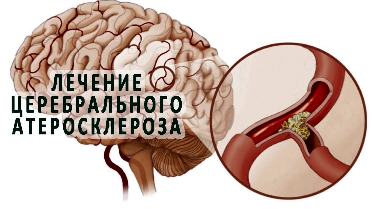 лечение церебрального атеросклероза