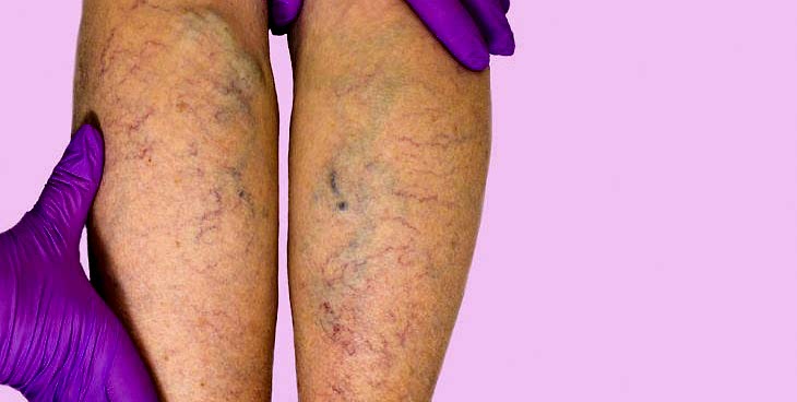 варикоз вен