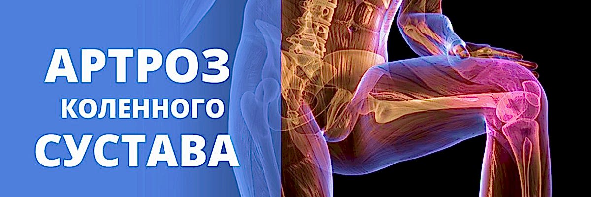 артроз коленного сустава