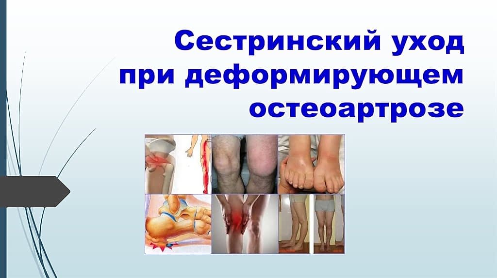 уход при остеоартрозе